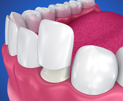 Faccette dentali Vedelago