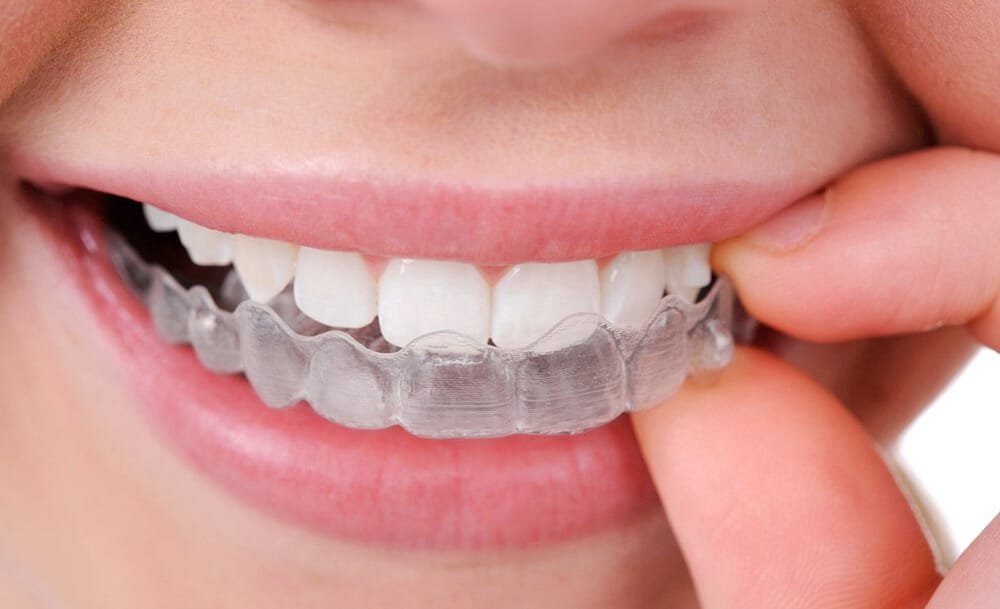 Sbiancamento Dentale